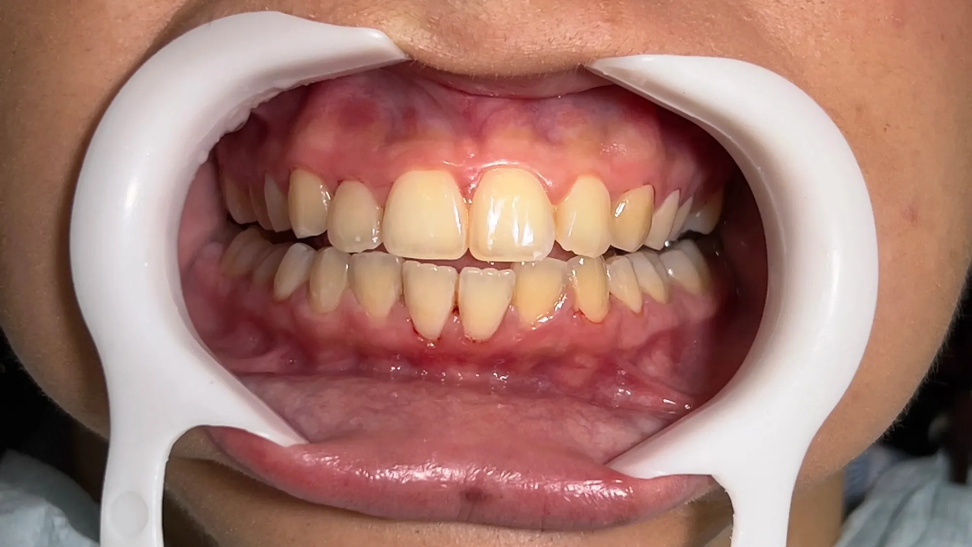 Antes do tratamento: Clareamento dental de consultório.